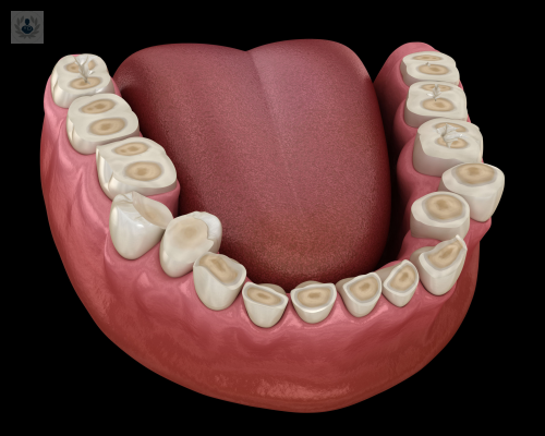 como-corregir-el-desgaste-dental imagen de artículo