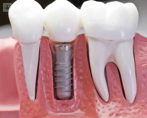 implantes-dentales-la-mejor-opcion-para-mantener-tu-boca-saludable imagen de artículo