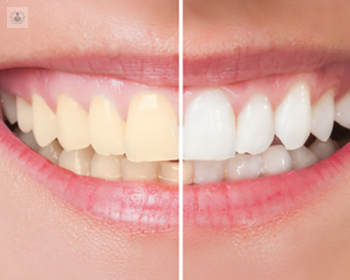 Blanqueamiento Dental, ¿qué sabe de este procedimiento?