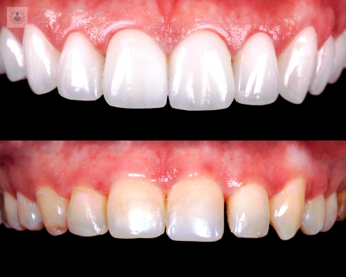 carillas-dentales-para-mejorar-el-aspecto-de-tus-dientes imagen de artículo