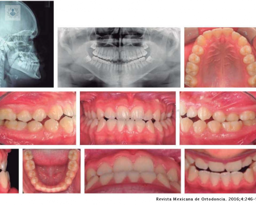 que-es-la-ortodoncia-pre-y-postquirurgica imagen de artículo