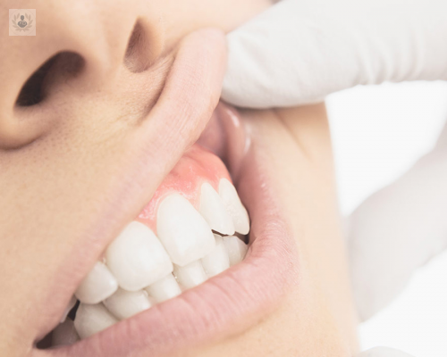 enfermedad-periodontal-una-patologia-recurrente-entre-la-poblacion imagen de artículo