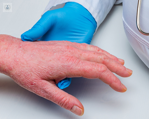 comezon-en-la-piel-podria-ser-dermatitis-atopica imagen de artículo