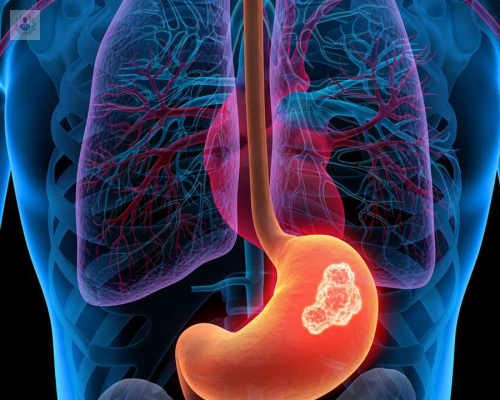 cancer-de-estomago-que-sabe-de-este-padecimiento imagen de artículo