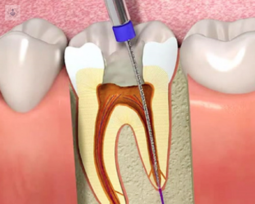 conoce-en-que-consiste-la-endodoncia-o-tratamiento-de-conductos imagen de artículo