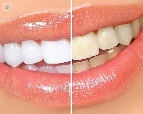 blanqueamiento-de-diente-no-vital-una-solucion-estetica imagen de artículo