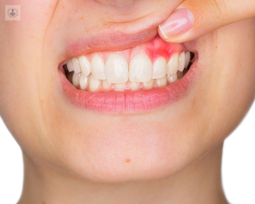 tratamiento-periodontal-antes-de-colocar-implantes-dentales imagen de artículo