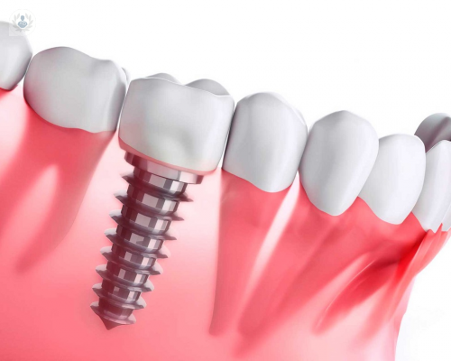 ¿Cuándo es importante realizar una colocación de implantes dentales?