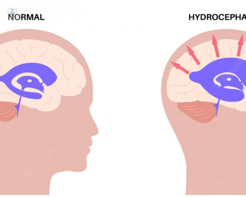 las-mejores-alternativas-para-tratar-la-hidrocefalia imagen de artículo