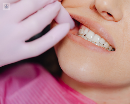 Blanqueamiento Dental y Aclaramiento Dental