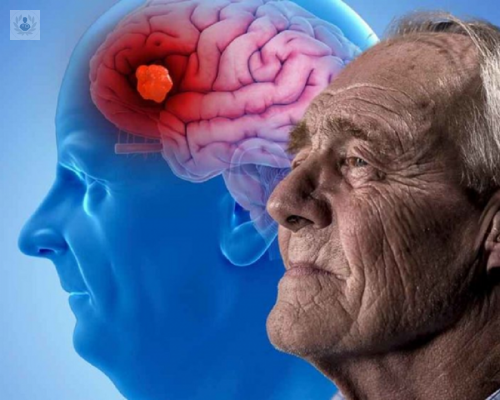 Enfermedad de Alzheimer: un trastorno neurodegenerativo