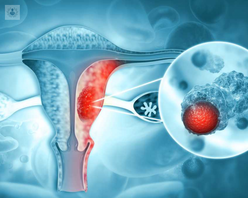 miomas-uterinos-enfermedad-hormonal-en-edad-fertil imagen de artículo