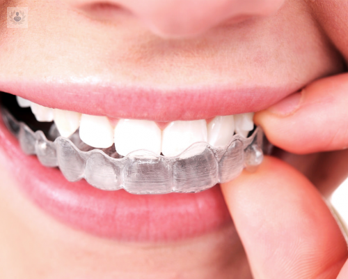 que-es-invisalign imagen de artículo