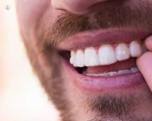 escaner-itero-element-para-alineadores-invisalign imagen de artículo