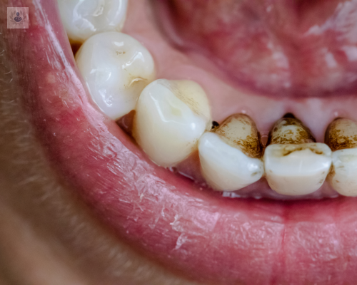 periodontitis-consecuencia-de-la-mala-higiene-bucal imagen de artículo