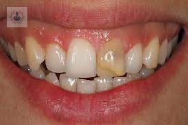 Aclaramiento Dental Interno, un procedimiento indoloro.