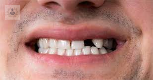 avulsion-dental-que-es-y-por-que-sucede imagen de artículo