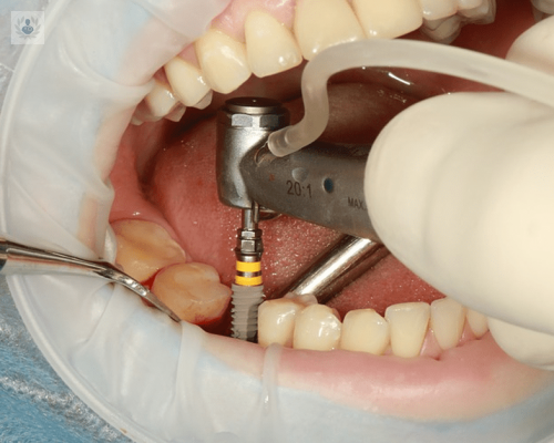 Implante Dental, luce una sonrisa estética y cuida de tu salud bucal