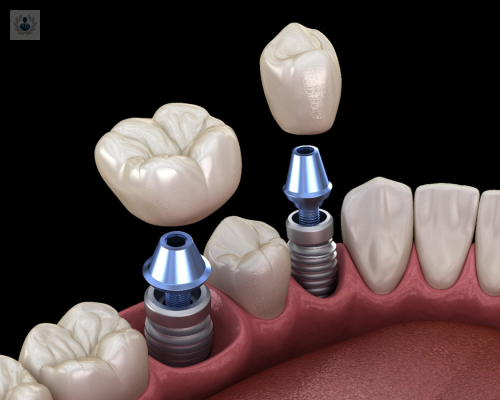 todo-sobre-el-mantenimiento-vital-de-la-rehabilitacion-de-implantes imagen de artículo