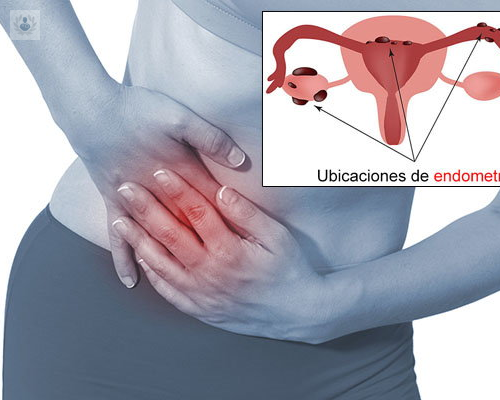 Características específicas de la Endometriosis