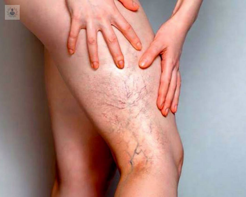 trombosis-venosa-profunda-un-padecimiento-que-debe-tratarse-a-tiempo imagen de artículo