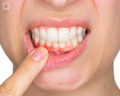 ¡No pierdas tus dientes! Atiende a tiempo la Enfermedad Periodontal