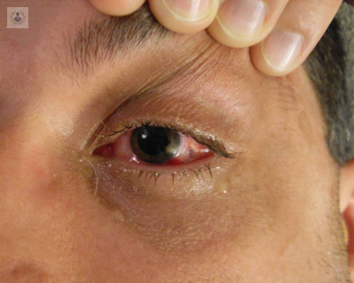 el-desprendimiento-de-retina-debe-ser-tratado-a-tiempo imagen de artículo