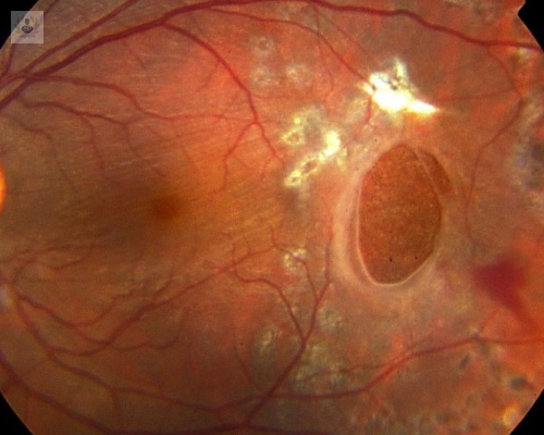 ¿Qué tratamientos existen para el Desprendimiento de Retina?