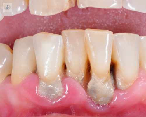 Diagnóstico Periodontal, signos y tratamiento