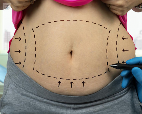 lipoabdominoplastia-la-mejor-forma-de-definir-la-silueta-y-eliminar-la-flacidez imagen de artículo
