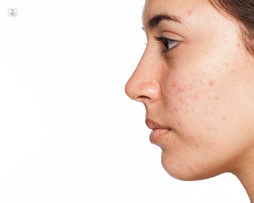 lo-que-hay-que-saber-sobre-el-acne imagen de artículo