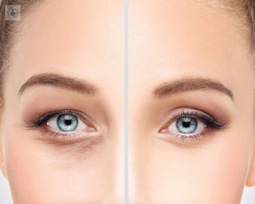 conoce-las-ventajas-de-la-blefaroplastia-laser imagen de artículo