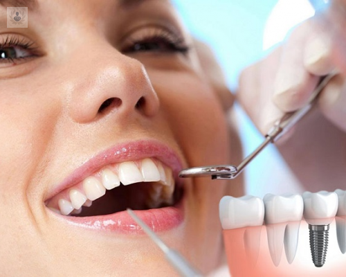 Implantes Dentales, funciones y ventajas