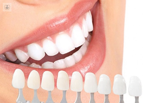 Estética Dental: todo lo que debes saber