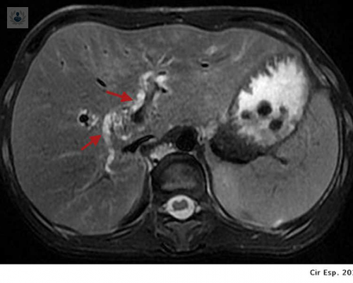 sabes-que-es-la-hepatolitiasis imagen de artículo