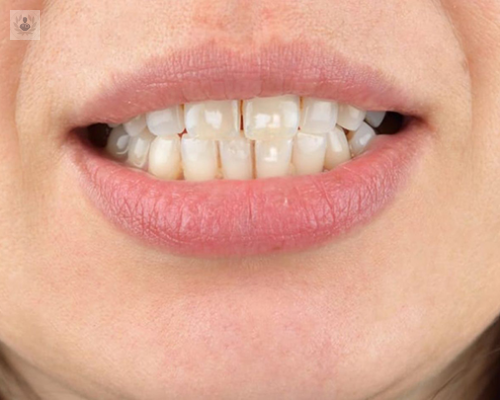 ¿Por qué se producen las manchas en los dientes?