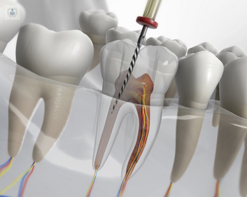 Tratamiento de conducto, llamado también Endodoncia