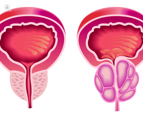 hiperplasia-prostatica-cual-es-el-mejor-tratamiento imagen de artículo