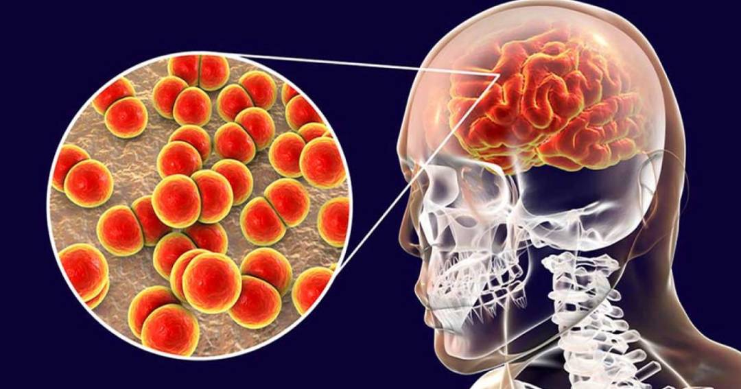 24 de abril: Día Mundial de la Meningitis