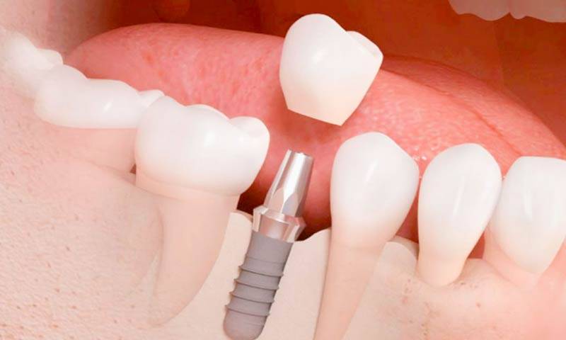 Implantes Dentales: la mejor opción para reemplazar una pieza dental