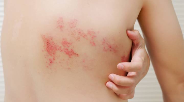 neuralgia-postherpetica-una-complicacion-del-herpes-zoster imagen de artículo