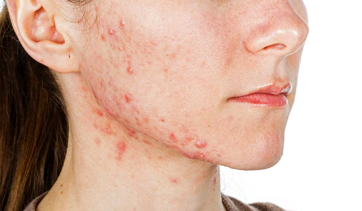 acne-una-enfermedad-que-debe-ser-tratada-por-especialistas imagen de artículo