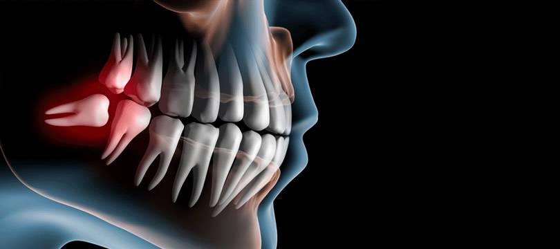 terceros-molares-cuando-es-necesario-extraerlos imagen de artículo