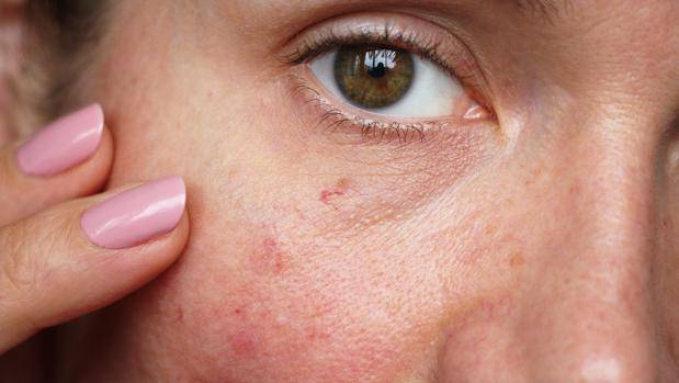Manchas en la Cara: causas, tratamiento y prevención
