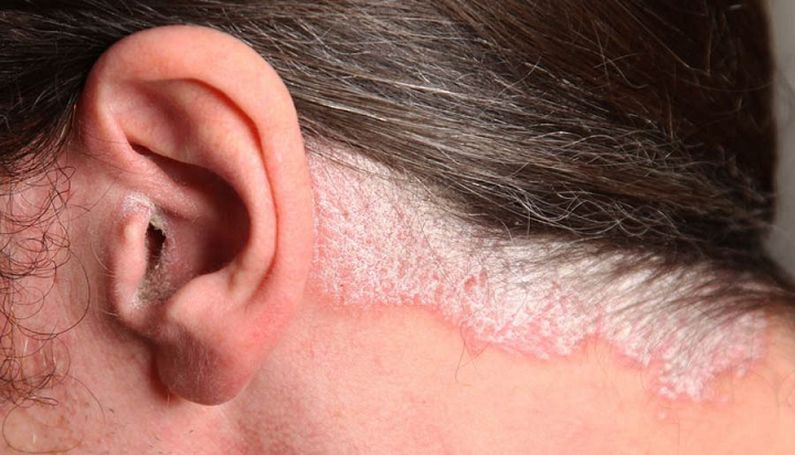 la-psoriasis-una-enfermedad-inflamatoria-de-la-piel-que-afecta-el-bienestar-social imagen de artículo