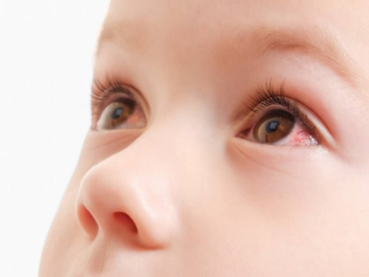 Uveítis en niños: una inflamación ocular que requiere atención temprana