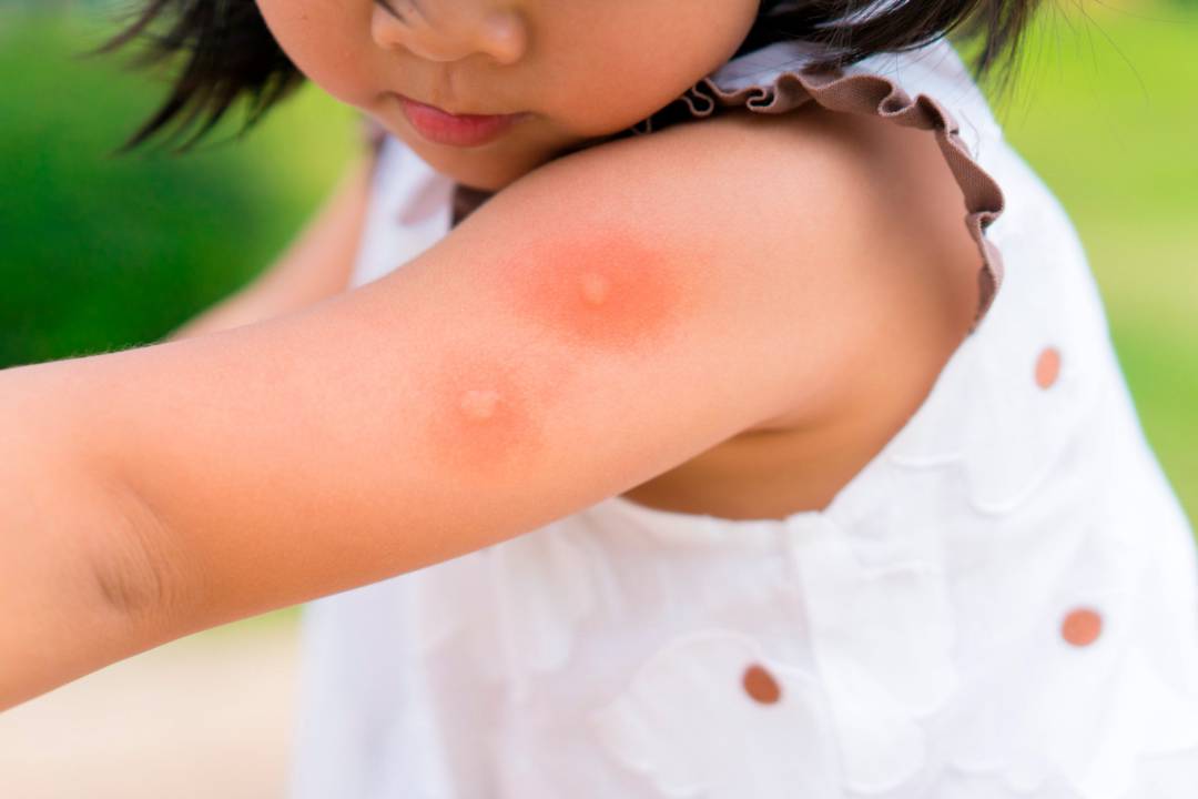 Alergia a picadura por veneno de insectos