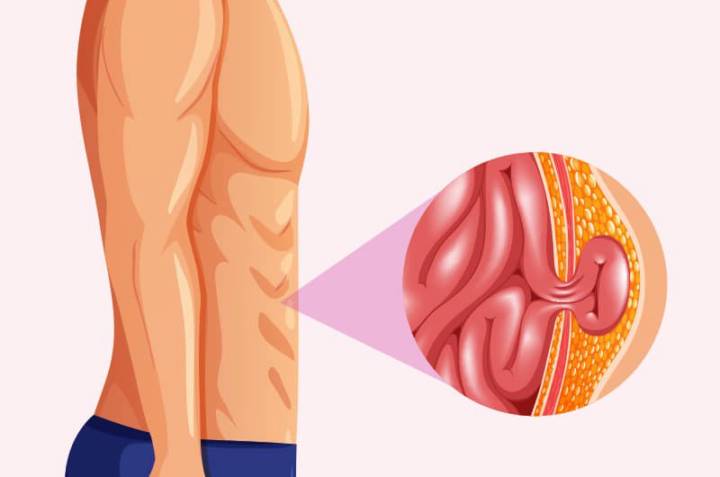 hernias-de-pared-abdominal-cuales-son-las-mejores-opciones-de-tratamiento imagen de artículo