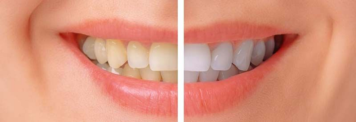 Beneficios del blanqueamiento dental: mejora estética y autoestima