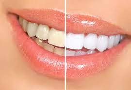 diseno-de-sonrisa-mejora-estetica-dental-integral imagen de artículo